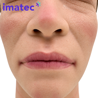 Facial Injection Training Head by Imatec Medical