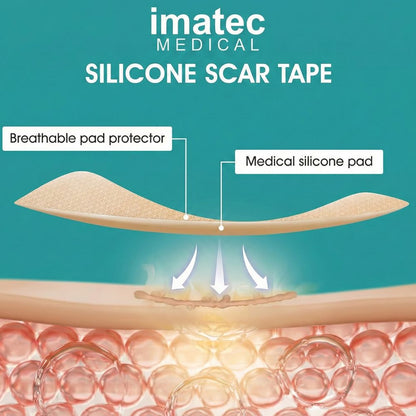 Silicone Scar Tape (4cm x 1.5m) Natural Beige by Imatec Medical