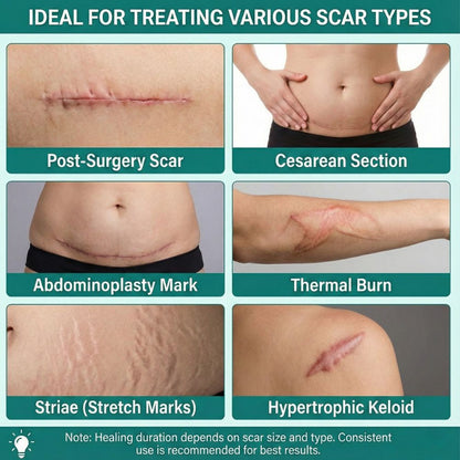 Silicone Scar Tape (4cm x 1.5m) Natural Beige by Imatec Medical