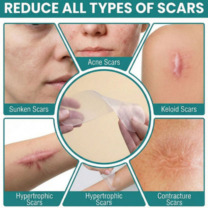 Restore Silicone Scar Sheet (150mmx15mm) by Imatec Medical